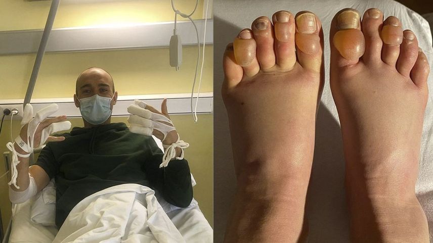 Einige Athleten haben schwerwiegende Erfrierungen davon getragen. Andreas Nygaard (links) war in medizinischer Behandlung im Spital.Fotos: z. Vgf.